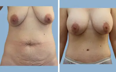 Before and After
